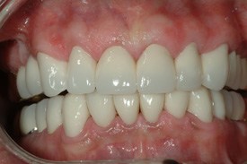 Restored and healthy smile after full reconstruction