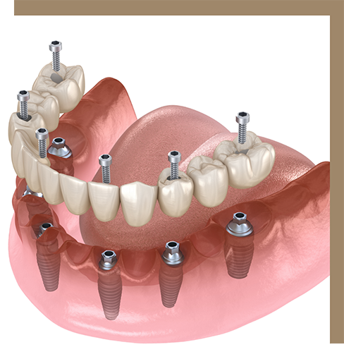 Illustration of dental implants supporting full dentures