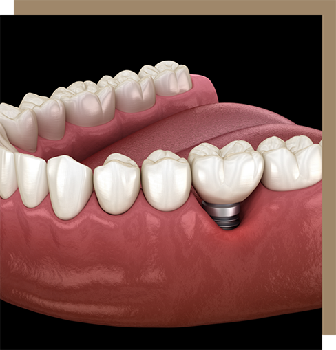 Illustration of a dental implant with a crown in the lower jaw