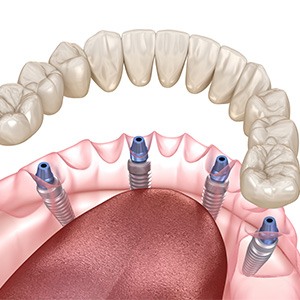 Example of implant dentures in Cocoa Beach