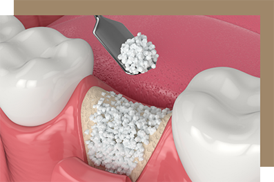 Illustration of a dental bone graft