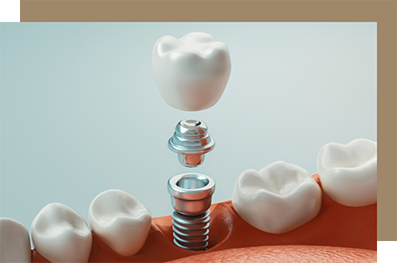 Dental implant with crown replacing one tooth