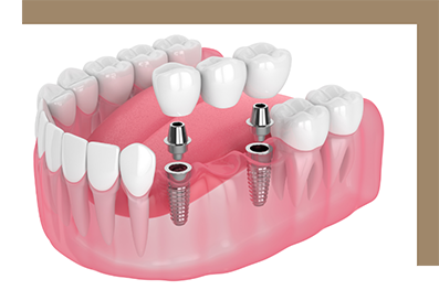 Two dental implants with bridge replacing three teeth
