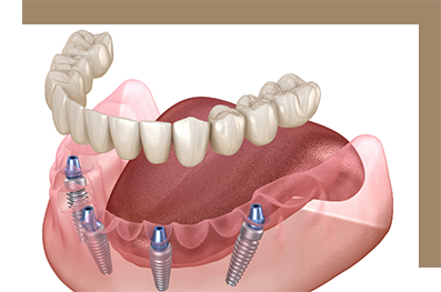 Four dental implants with a denture replacing a row of teeth
