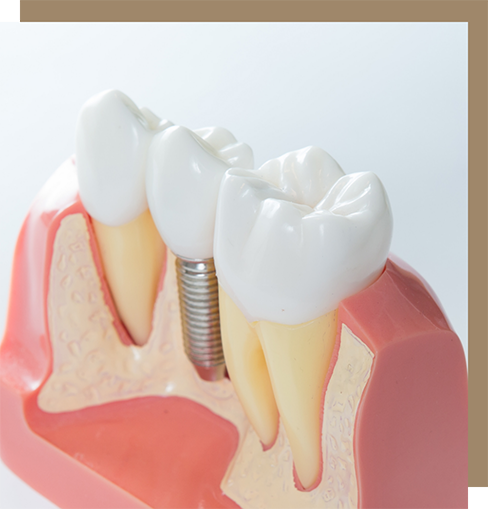 Model of natural teeth on either side of a dental implant
