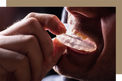 Man placing a mouthguard over his teeth