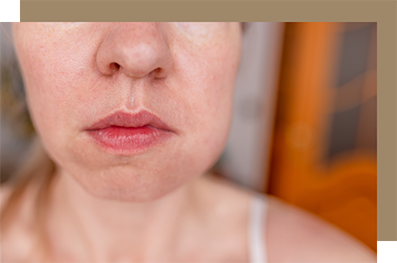 Woman with swelling on one side of her jaw