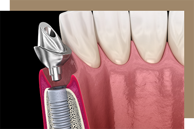 Illustration of an abutment screwed onto a dental implant post in the jawbone