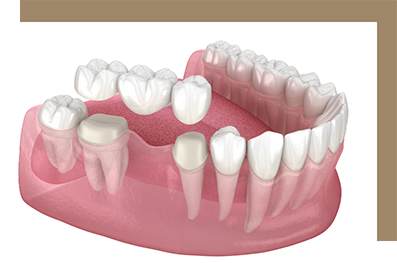 Model of a dental bridge