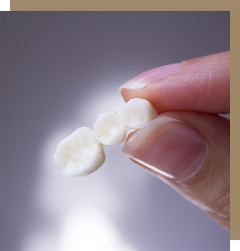 Holding a three-unit dental bridge