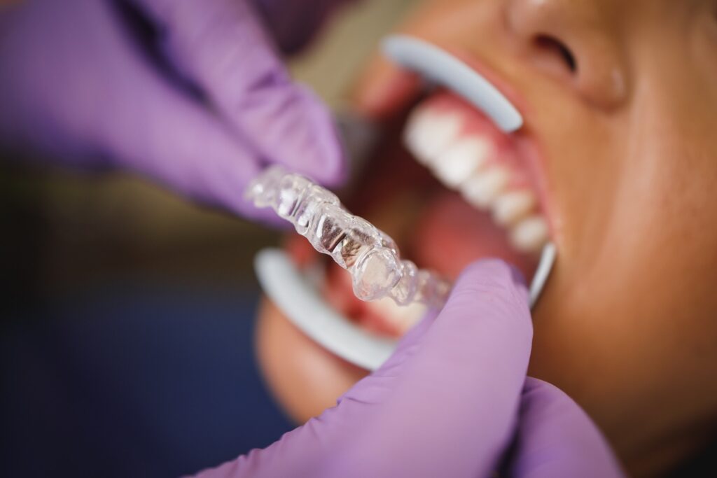 Dentist placing clear aligner on patient's bottom teeth